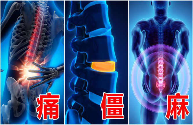 腰椎間盤突出怎么治療 腰椎間盤突出怎么治療