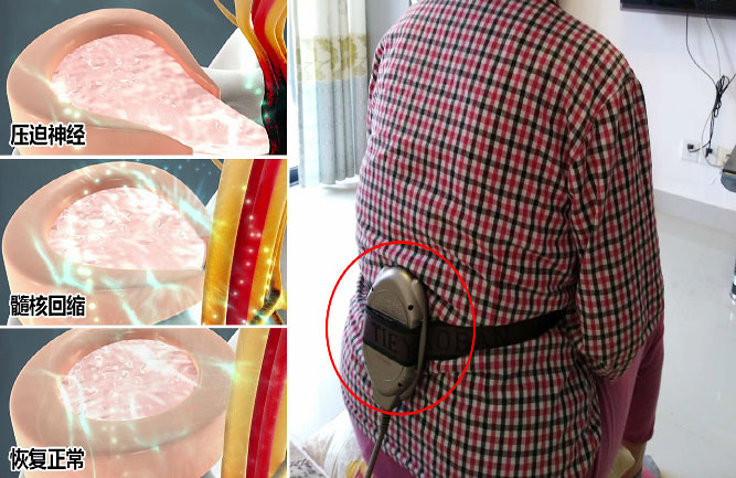 腰間盤突出什么癥狀 腰間盤突出什么癥狀