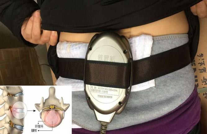 鐵腰板治療腰間盤(pán)突出效果最好 鐵腰板治療腰間盤(pán)突出效果最好